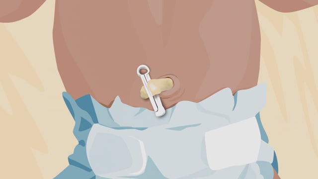 How to Care for Your Newborn's Umbilical Cord