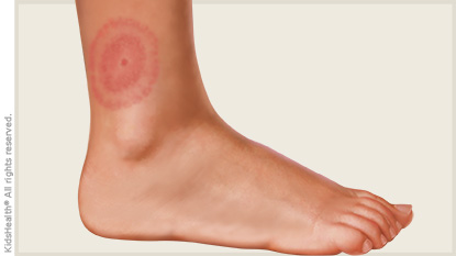 Ankle with a red circular bullseye rash around a tick bite.