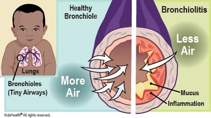 Bronchiolitis is an infection of the respiratory tract. Tiny airways called bronchioles swell and fill with mucus, which can make breathing hard.