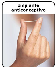 Implante anticonceptivo
