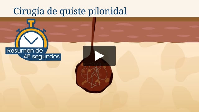Resumen de 45 segundos: Cirugía de quiste pilonidal