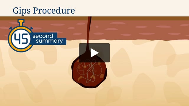 45-Second Summary: Gips Procedure