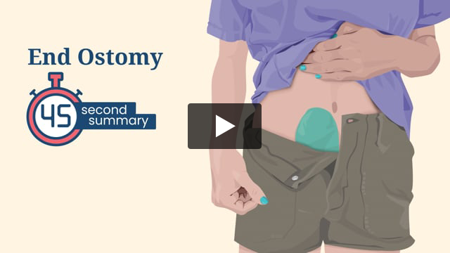 45 Second Summary: End Ostomy