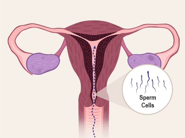 During sex, sperm cells travel through the vagina to the uterus and fallopian tubes.In the fallopian tube, the sperm meets the egg that was released from the ovary during ovulation.