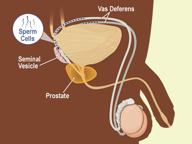 The prostate gland is a walnut-sized gland that surrounds a portion of the urethra and produces some of the fluid in semen.