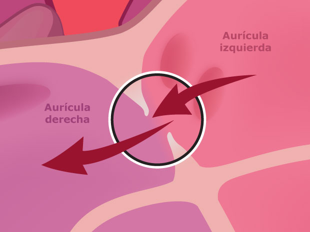Este orificio (agujero) permite que parte de la sangre procedente de la aurícula izquierda retroceda hacia la aurícula derecha en lugar de salir del corazón a través del ventrículo izquierdo.