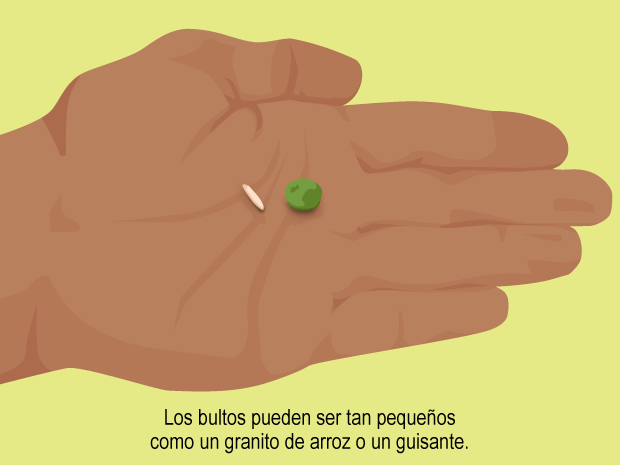 Si notas algún tipo de hinchazón, bultos o cambios en el tamaño o el color del testículo, informa a tu médico de inmediato. Infórmale también si sientes cualquier dolor o áreas molestas en las ingles.Los bultos o la hinchazón no han de implicar la presencia de un cáncer, pero el médico los debería examinar lo antes posible.El cáncer de testículo casi siempre se puede curar si se detecta y se trata pronto.