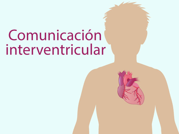 Una comunicación interventricular (CIV) a veces se llama "orificio (agujero) en el corazón". Es una anomalía congénita.  Haz clic en estas diapositivas para obtener más información sobre este problema cardíaco.