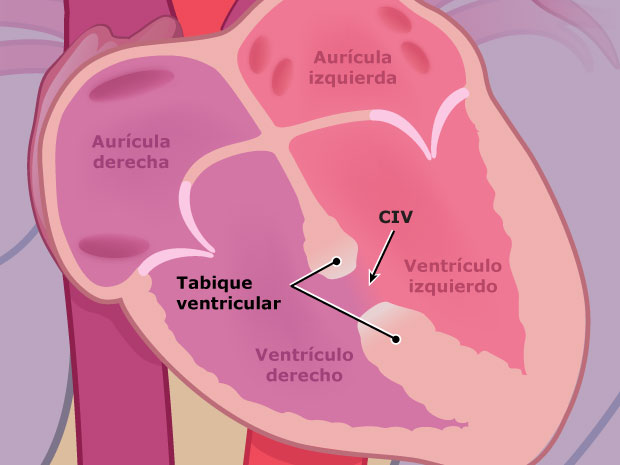 Cuando una persona tiene una comunicación interventricular, presenta una abertura en el tabique entre los ventrículos derecho e izquierdo. Esta parte del tabique se llama "tabique ventricular".