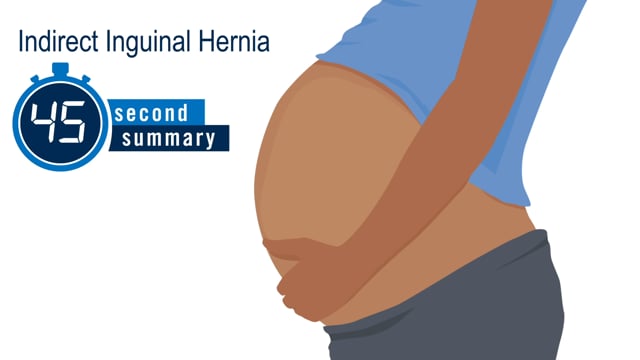 45-Second Summary: Indirect Inguinal Hernia