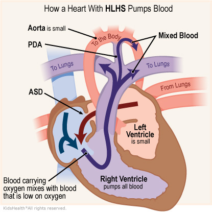 How a heart with HLHS pumps