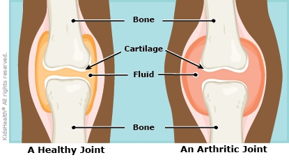 arthritis illustration