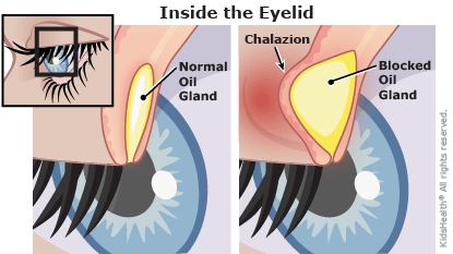 A To Z Chalazion for Parents Humana Louisiana A To Z Chalazion for Parents Humana Louisiana