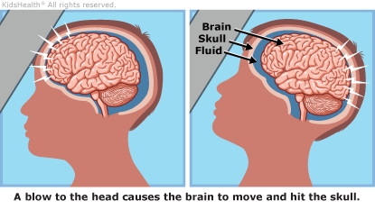 concussion illustration