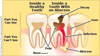 dental abscess illustration