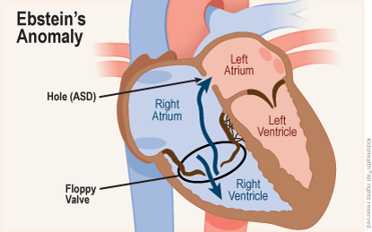 Diagram shows close-up, cross section of the heart with Ebstein's anomaly.  Some blood flows normally from the right atrium through a floppy valve into the right ventricle.  But a hole in the septum (ASD) also allows blood flow directly from the right atrium into the left atrium.