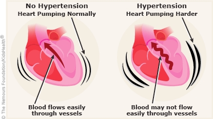 https://www.kidshealth.org/content/dam/patientinstructions/en/images/hypertension_a_enIL.jpg