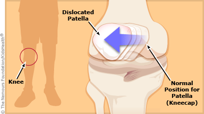 A look at how the kneecap moves from its normal position in a patellar dislocation.