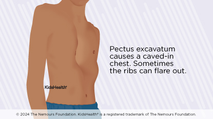 Pectus excavatum causes a caved-in chest. Sometimes the ribs can flare out.