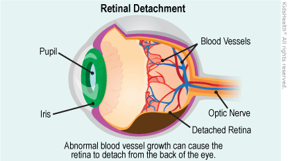 ROP retinal detachment illustration
