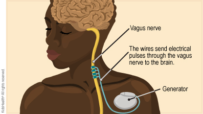 Inside the chest, wires come out of a generator and go to the vagus nerve. The wires send electrical pulses through the vagus nerve to the brain.	
