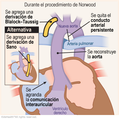 Illustration showing changes made during Norwood Procedure