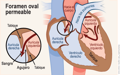 Se muestran dos ilustraciones. Una ilustración muestra un foramen oval permeable, donde la sangre continúa fluyendo, a través del orificio del tabique, de la aurícula izquierda a la aurícula derecha. Este orificio se cierra después del nacimiento.