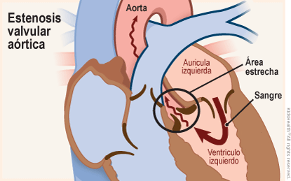 Se muestra un corte transversal del corazón con estenosis aórtica, que es cuando se crea un área estrecha en la válvula aórtica. La sangre fluye desde la aurícula izquierda hacia el ventrículo izquierdo, pero luego el flujo se reduce o bloquea cuando trata de pasar a través de la válvula con dirección hacia la aorta.