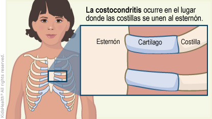 Illustration: costochondritis