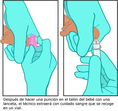 Despu&eacute;s de hacer una punci&oacute;n en el tal&oacute;n del beb&eacute; con una lanceta, el t&eacute;cnico extraer&aacute; con cuidado sangre que se recoge en un vial.