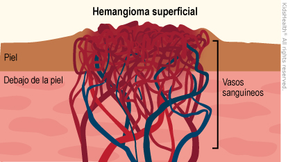 Los hemangiomas superficiales crecen en la superficie de la piel. También se les llama hemangiomas de fresa o marcas de fresa debido a su apariencia roja y abultada.