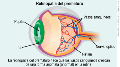 ilustracion retinopatia de la prematuridad